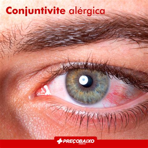 conjuntivite alérgica-4